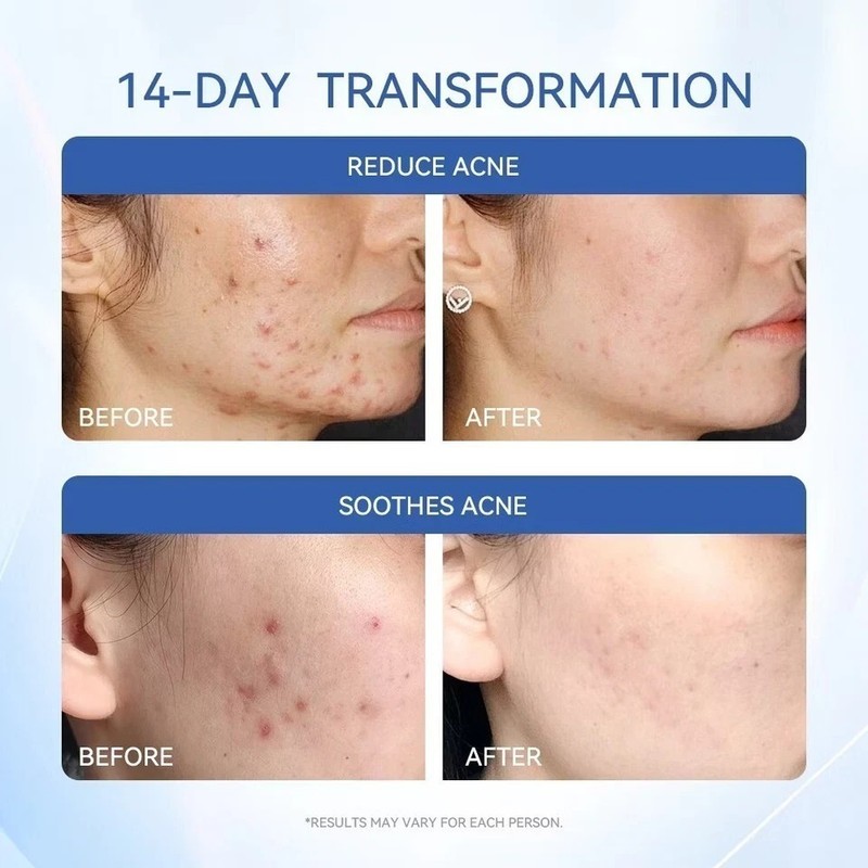 Dr. Leo Acne Essence – Salicylic Acid Serum for Acne & Scars NEW gallery