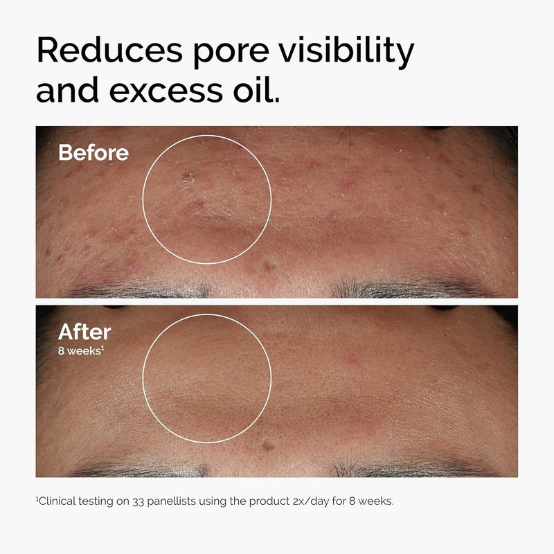 The Ordinary Niacinamide 10% + Zinc 1%, Smoothing Serum for Blemish-Prone Skin gallery