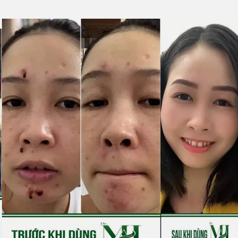 2 x Dr Mai Acne Serum Reduce Acne Scar & Hidden Acne & Skin Recovery Serum gallery
