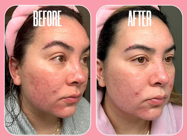 Glycolic Acid 20% Resurfacing Pads - Exfoliating Peel Pads Vitamins & Green Tea gallery