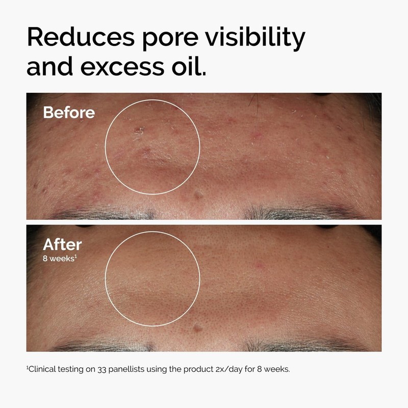 The Ordinary Niacinamide 10% + Zinc 1%, Brightening & Smoothing Serum 30g gallery
