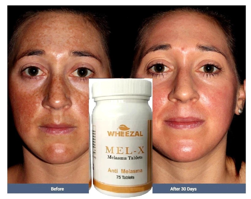 Melasma Treatment EX 75tablets Authentic Stain Improvement Skin Care Whitening