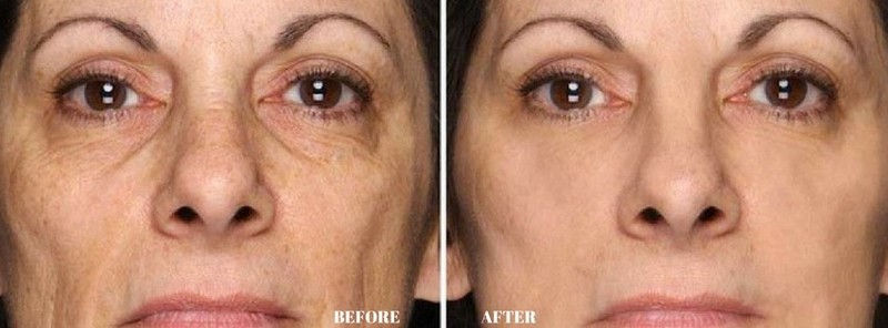 Antioxidant boost - ANTI-WRINKLE COMPLEX - resveratrol keratin - 2 Bottles gallery