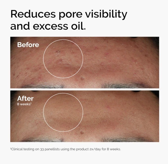 The Ordinary Niacinamide 10% + Zinc 1%, Smoothing Serum for Blemish-Prone Skin gallery