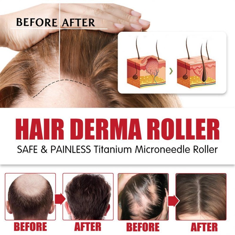 Beard and Hair Growth Derma Roller 0.5mm Titanium Derma Roller USA Fast Shipping gallery