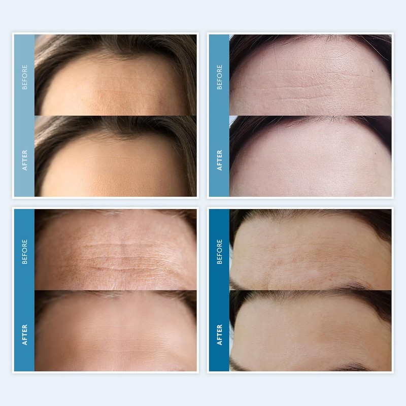 Dersie Silicone Forehead Wrinkle Patches Reusable Anti Wrinkle Pads for Wrinkles gallery
