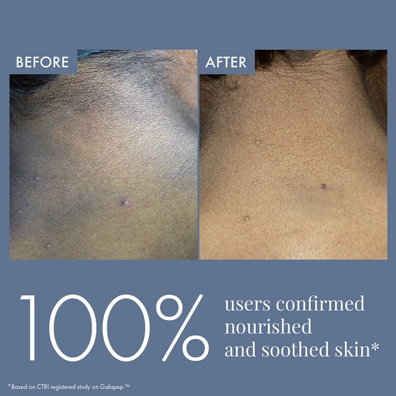 ThriveCo Dark Patches Corrector Cream| Dark Patches Removal 100ml gallery