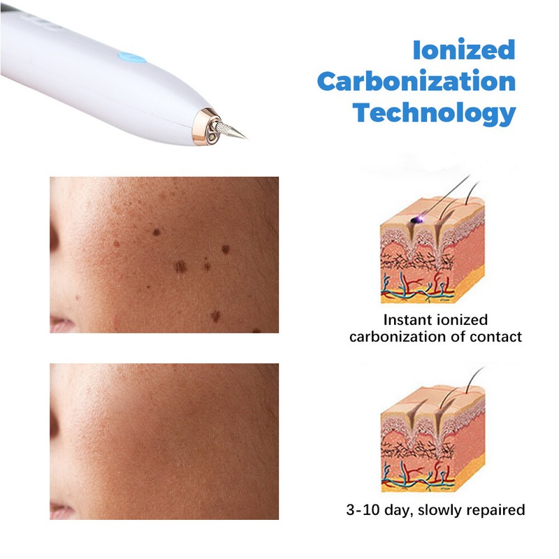 Laser Plasma Pen Dark Spots Skin Tags Tattoo Mole Wart Remover Pen Mole Removal gallery
