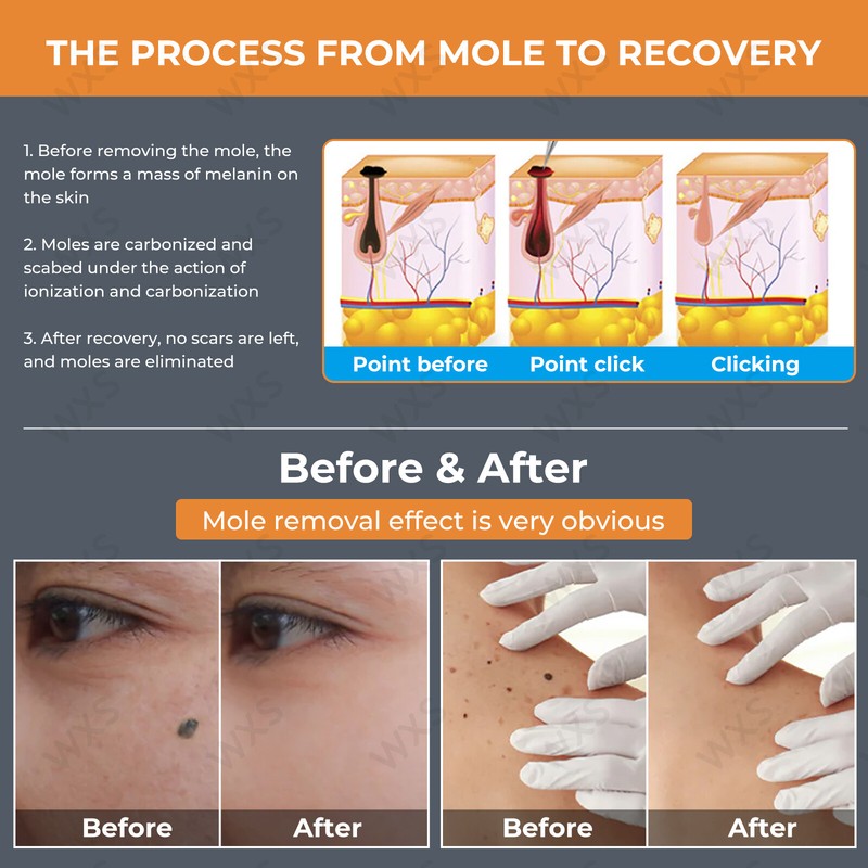 Skin Tag Remover - Skin Tag and Mole Remover for Home Use, Portable Removal Kit gallery