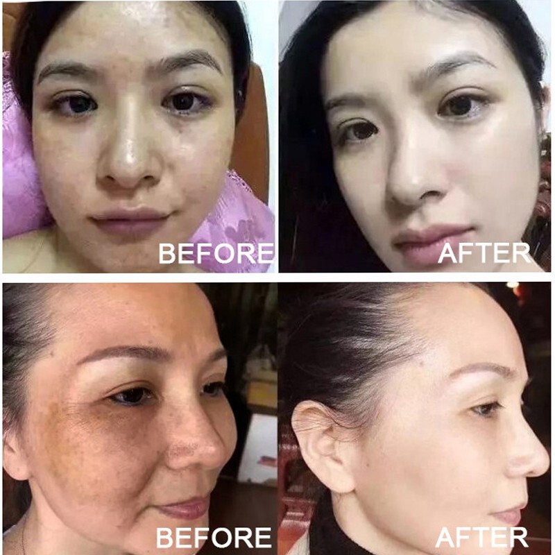 Turmeric Freckle Whitening Serum Curcumin Oil Face Brighten Fade Dark Spot Remov gallery