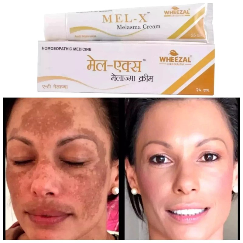 Wheezal Mel-X Melasma Cream – Natural Treatment for Skin Pigmentation