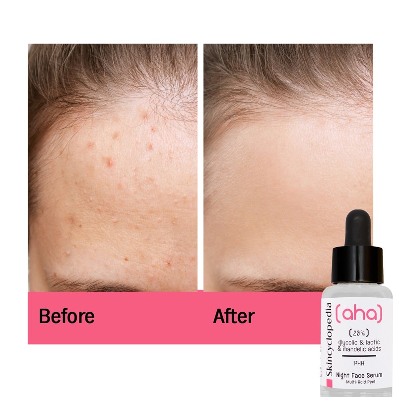 Skincyclopedia Facial Serum Treatment, Glycolic Acid, Brighter Skin & Bumpy Skin gallery