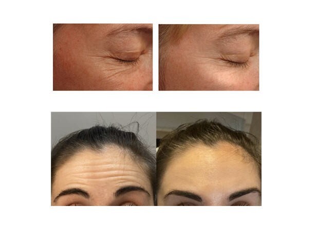 1 Liter Palmitoyl Tripeptide-38 Forehead Crow’s Feet Wrinkle Reduce Peptide