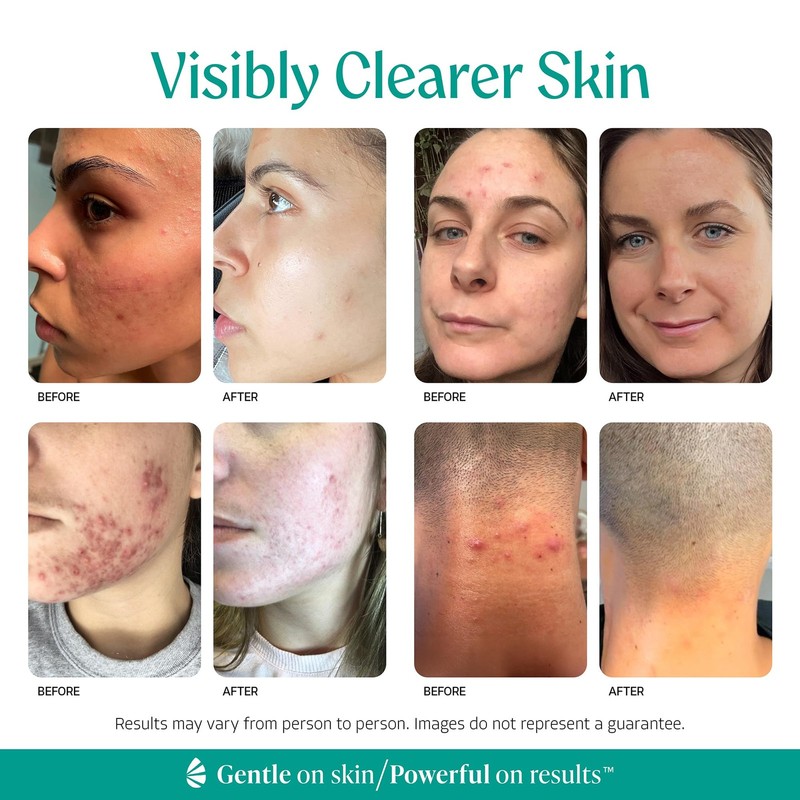 Face & Body Clearing Serum, Level 1- for acne, folliculitis, aging skin, ingr... gallery