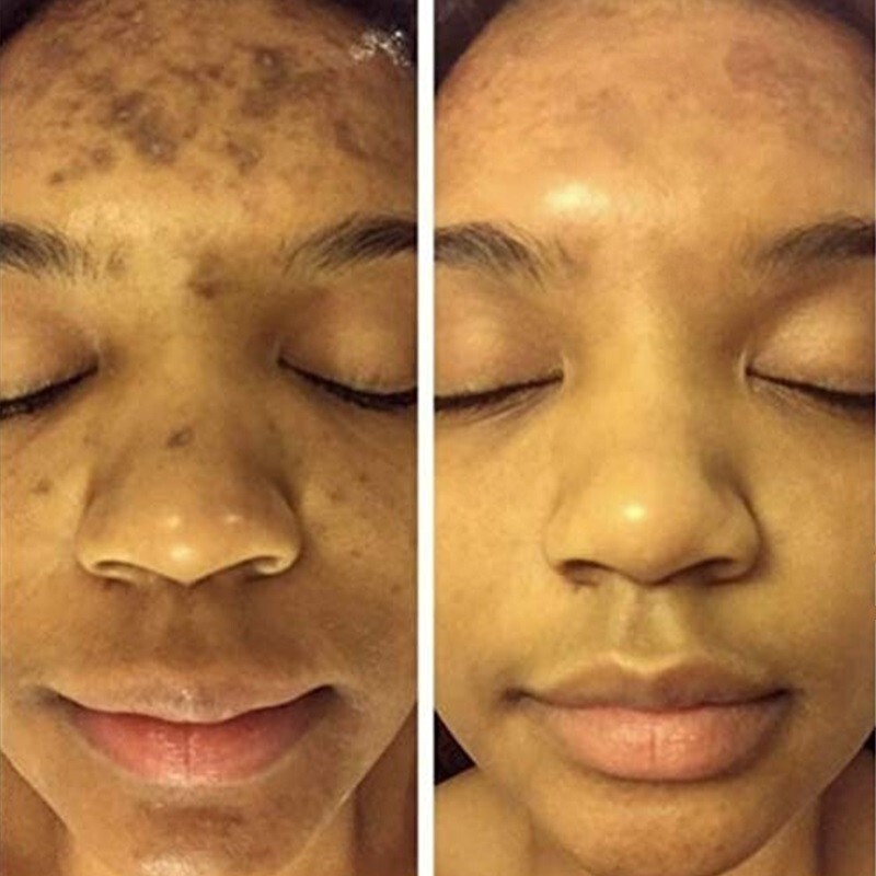 Turmeric Freckle Whitening Serum Curcumin Oil Face Brighten Fade Dark Spot Remov gallery