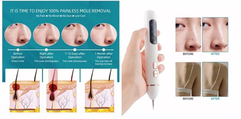 Laser Plasma Pen Mole Removal Dark Spot Remover Skin Wart Tag Tattoo Anti-Aging gallery
