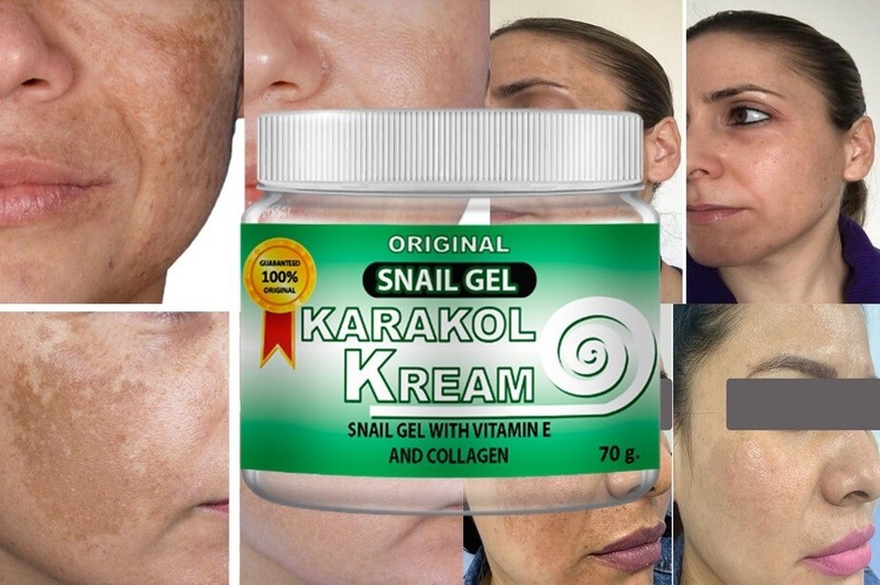 Karakol-kream cream acne gel dark spots skincare face hands moisture