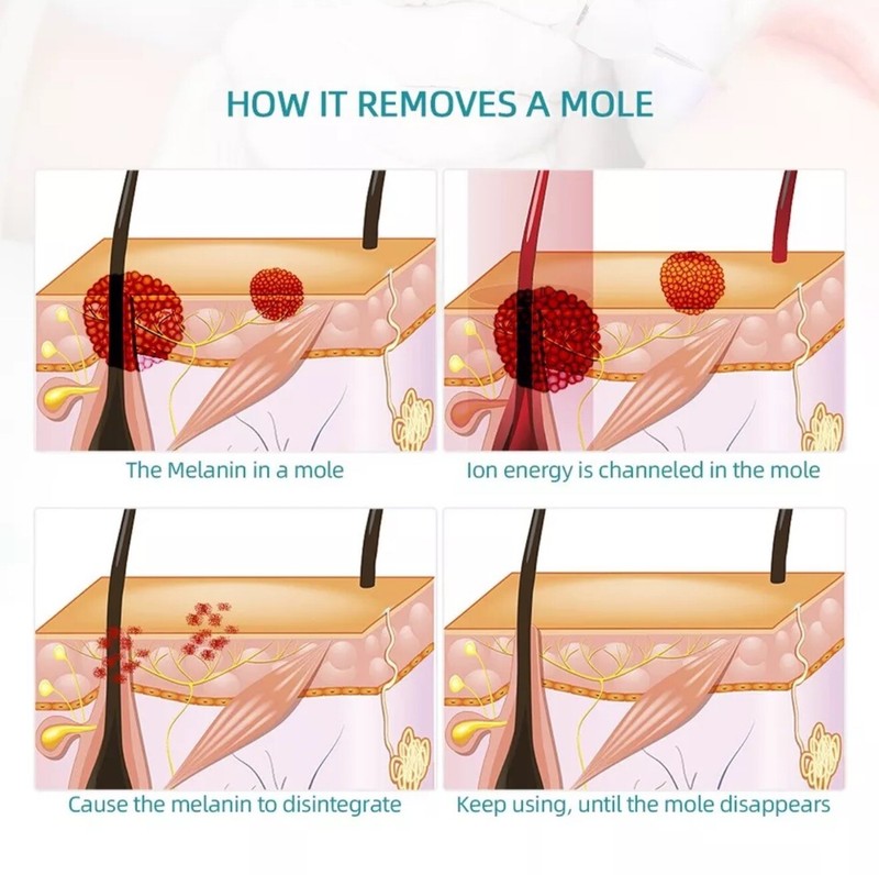 Laser Plasma Pen Mole Removal Dark Spot Remover Skin Wart Tag Tattoo Anti-Aging gallery