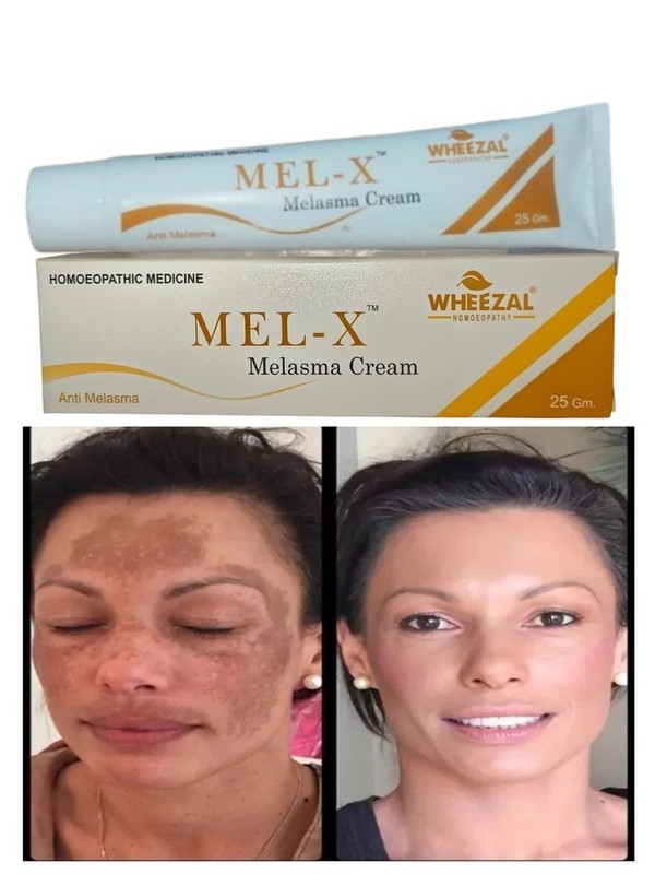 Wheezal Mel-X Melasma Cream for skin pigmentation like melasma, chloasma (25g)
