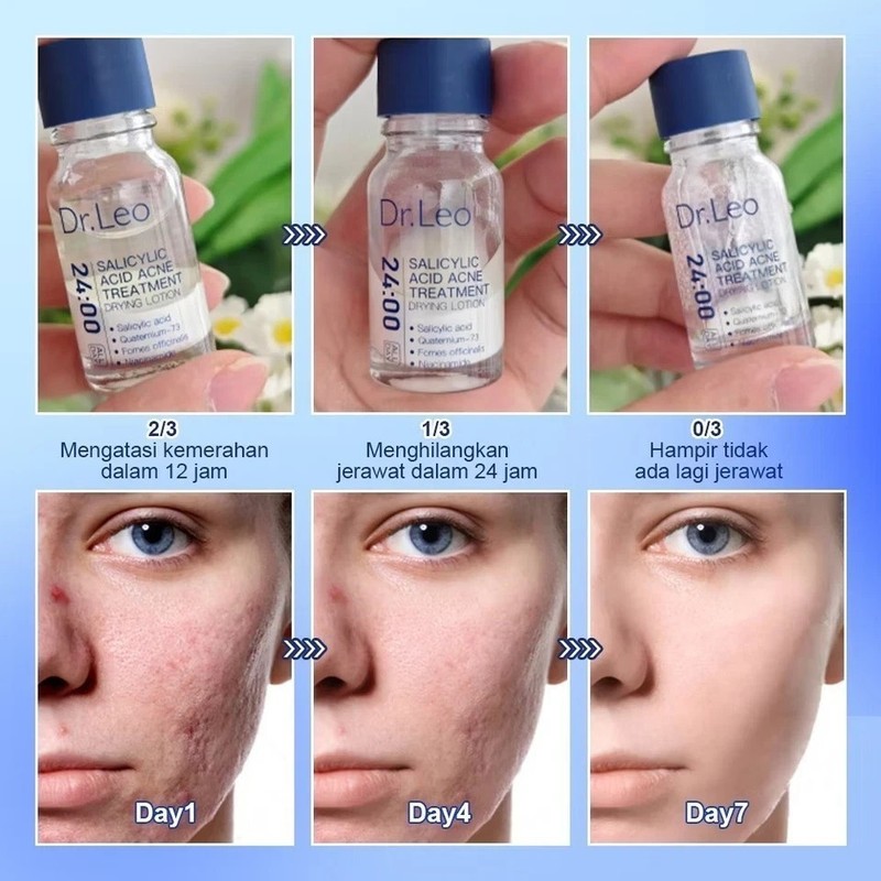 Dr. Leo Acne Essence – Salicylic Acid Serum for Acne & Scars NEW gallery