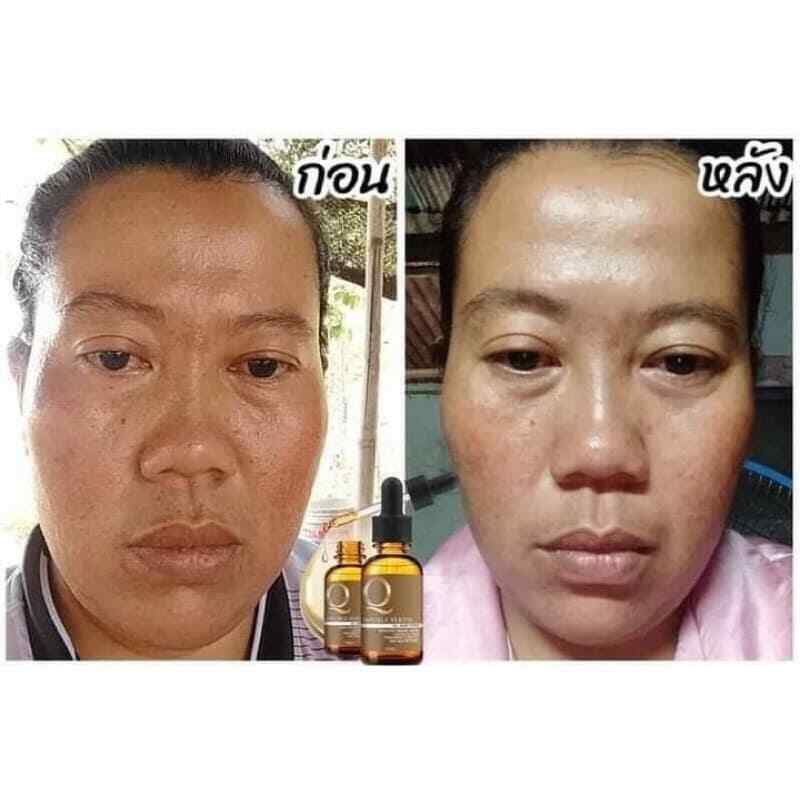 6 x Q Double Serum Reduce Wrinkles Freckles Dark Spots Aura Skin Melasma gallery