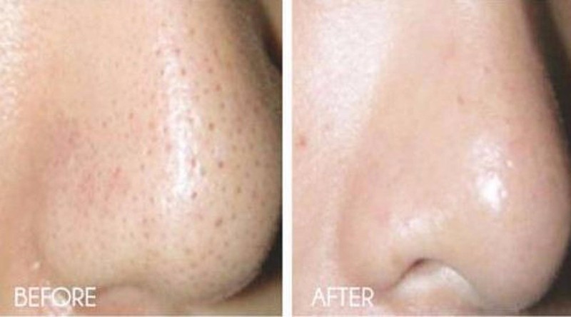 20% Pumpkin Enzyme Rapid Clear Skin Peel w/ Glycolic Lactic Salycylic Acid,CoQ10 gallery
