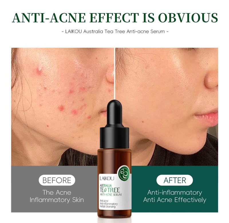 AUSTRALIATES Tea TREE ANTI-“ACNE SERUM” Anti-acneAnti-inflammatory
