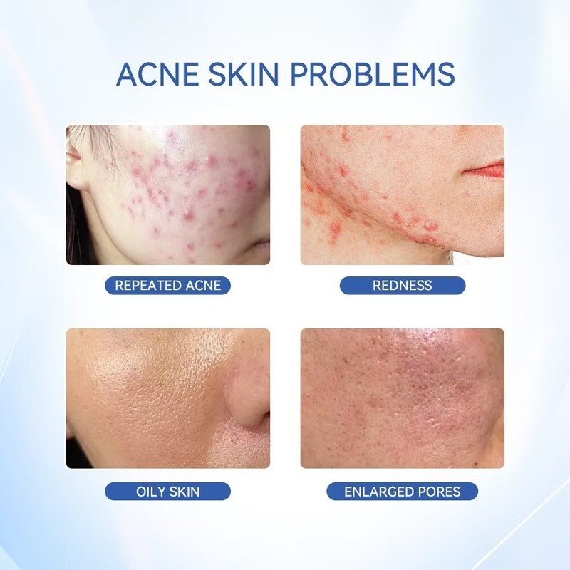NEW Dr.Leo Acne Essence Salicylic Acid Anti-acne Serum Lighten Acne Scars acne gallery