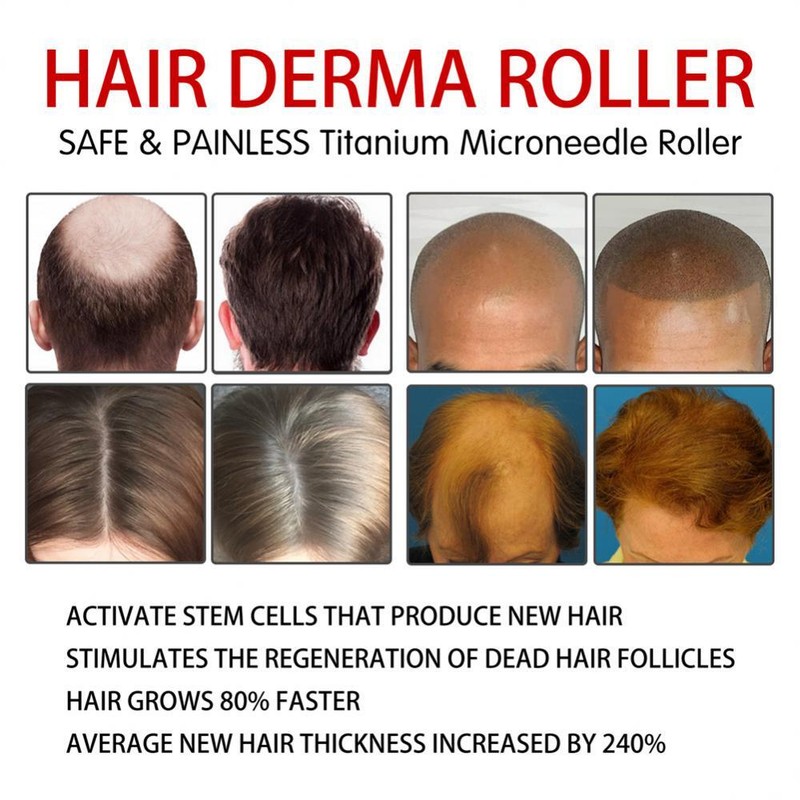 Beard and Hair Growth Derma Roller 0.5mm Titanium Derma Roller USA Fast Shipping gallery