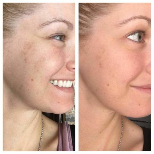 Niacinamide Vitamin B3 Serum Cream with Hyaluronic Acid Anti Aging Wrinkle Acne gallery