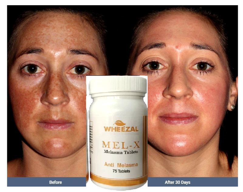 Melasma Treatment EX 75tablets Authentic Stain Improvement Skin Care Whitening
