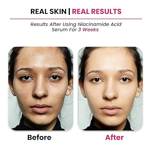 Thriveco 10% Niacinamide Face Serum + 1% Zinc Pca Glowing Skin, Acne-prone 30ml gallery
