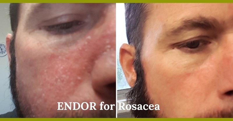 Rosacea Cream, for red face rosacea and removes fine lines gallery