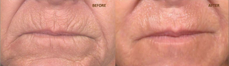 10 ML -UPPER LIP PLUMPER COMPLEX LIP PERIORAL FILLER ~CHAPPED LIPS NO MORE! gallery